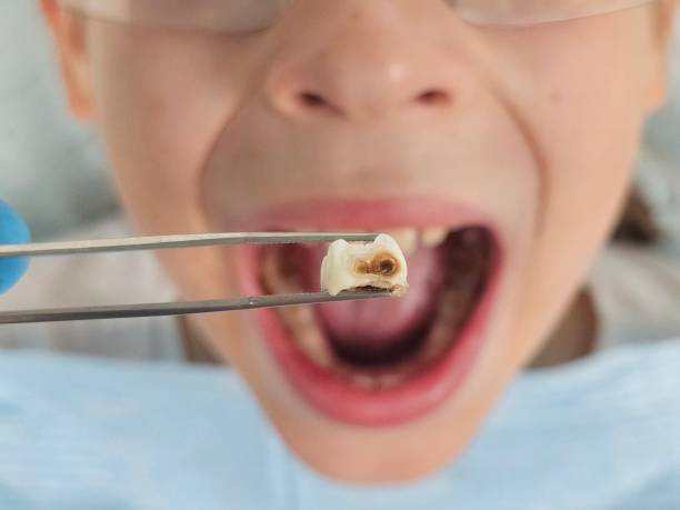 Urgent Tooth Repair in WI