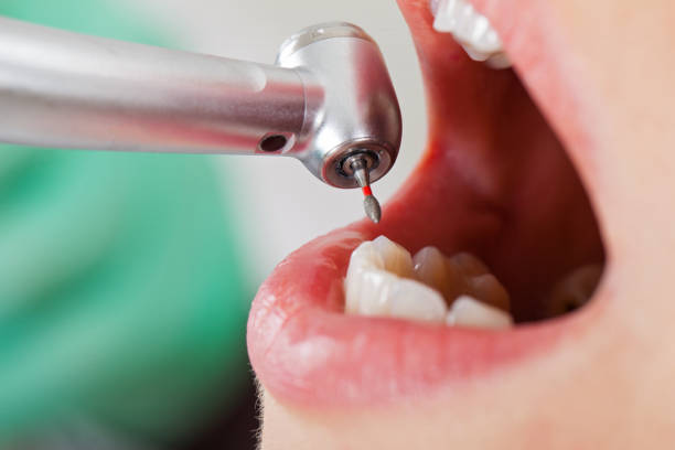 Best Chipped Tooth Repair Near Me  in Powers Lake, WI